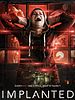 Implanted posteri