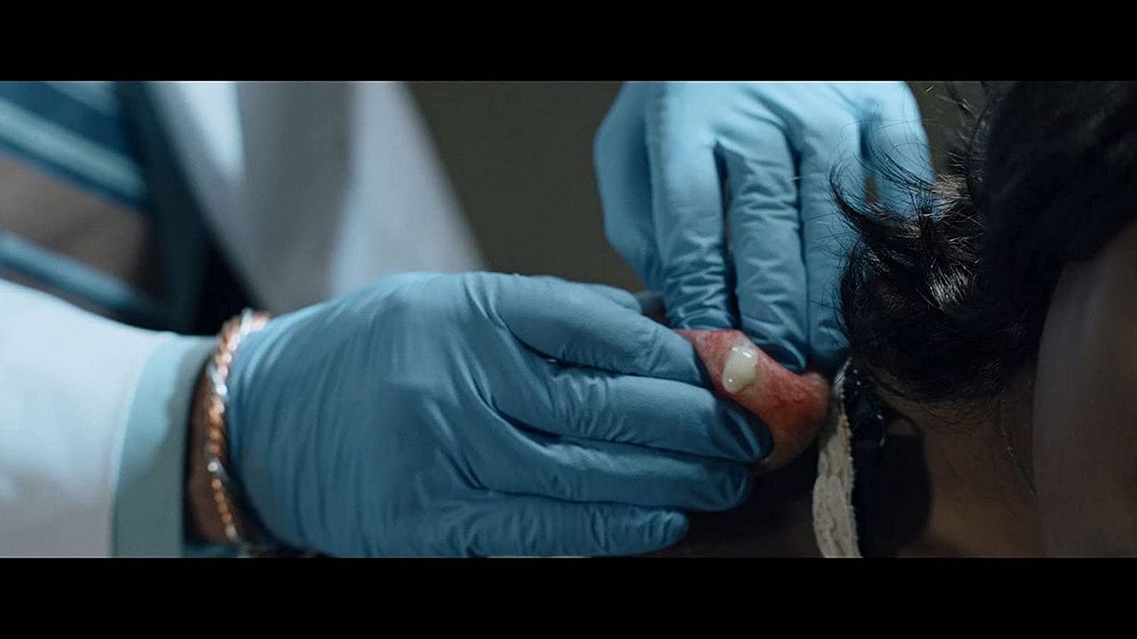Cyst : Fotoğraf